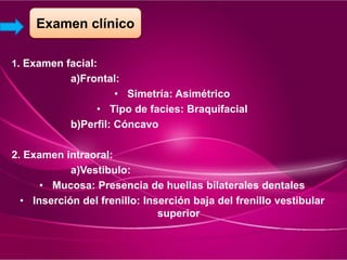 1. Examen facial:
a)Frontal:
• Simetría: Asimétrico
• Tipo de facies: Braquifacial
b)Perfil: Cóncavo
2. Examen intraoral:
a)Vestíbulo:
• Mucosa: Presencia de huellas bilaterales dentales
• Inserción del frenillo: Inserción baja del frenillo vestibular
superior
Examen clínico
 