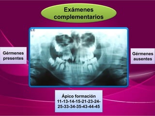 Exámenes
complementarios
Ápico formación
11-13-14-15-21-23-24-
25-33-34-35-43-44-45
Gérmenes
presentes
Gérmenes
ausentes
 