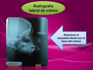 Radiografía
lateral de cráneo
Relaciona el
esqueleto facial con la
base del cráneo
 