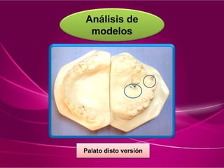 Análisis de
modelos
Palato disto versión
 