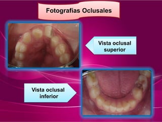 Fotografías Oclusales
Vista oclusal
inferior
Vista oclusal
superior
 