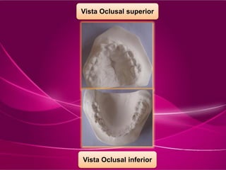 Vista Oclusal superior
Vista Oclusal inferior
 