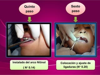Quinto
paso
Sexto
paso
Instalado del arco Nitinol
( N° 0.14)
Colocación y ajuste de
ligaduras (N° 0.20)
 
