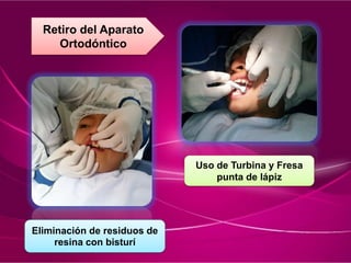 Retiro del Aparato
Ortodóntico
Eliminación de residuos de
resina con bisturí
Uso de Turbina y Fresa
punta de lápiz
 