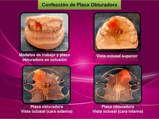 Modelos de trabajo y placa
obturadora en oclusión
Vista oclusal superior
Placa obturadora
Vista oclusal (cara externa)
Placa obturadora
Vista oclusal (cara interna)
Confección de Placa Obturadora
 