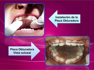 Instalación de la
Placa Obturadora
Placa Obturadora
Vista oclusal
 