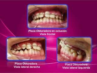 Placa Obturadora
Vista lateral derecha
Placa Obturadora en oclusión
Vista frontal
Placa Obturadora
Vista lateral izquierda
 