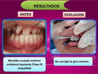 RESULTADOS
ANTES EVOLUCION
Mordida cruzada anterior
unilateral izquierda Clase III
esqueletal
Se corrigió la giro versión
 