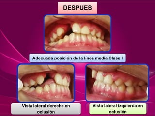 DESPUES
Adecuada posición de la línea media Clase I
Vista lateral derecha en
oclusión
Vista lateral izquierda en
oclusión
 