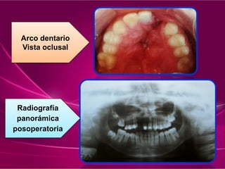 Radiografía
panorámica
posoperatoria
Arco dentario
Vista oclusal
 