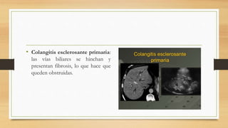 • Colangitis esclerosante primaria:
las vías biliares se hinchan y
presentan fibrosis, lo que hace que
queden obstruidas.
 