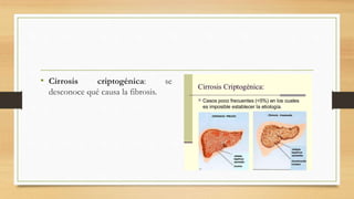 • Cirrosis criptogénica: se
desconoce qué causa la fibrosis.
 
