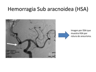 Hemorragia Sub aracnoidea (HSA)

Imagen por DSA que
muestra HSA por
rotura de aneurisma.

 