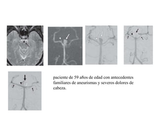 paciente de 59 años de edad con antecedentes
familiares de aneurismas y severos dolores de
cabeza.

 