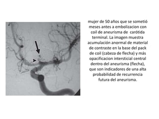 mujer de 50 años que se sometió
meses antes a embolizacion con
coil de aneurisma de carótida
terminal. La imagen muestra
acumulación anormal de material
de contraste en la base del pack
de coil (cabeza de flecha) y más
opacificacion intersticial central
dentro del aneurisma (flecha),
que son indicadores de una alta
probabilidad de recurrencia
futura del aneurisma.

 