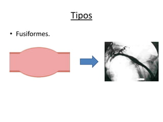 Tipos
• Fusiformes.

 