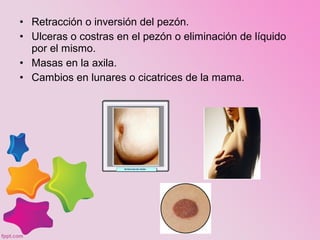 • Retracción o inversión del pezón.
• Ulceras o costras en el pezón o eliminación de líquido
por el mismo.
• Masas en la axila.
• Cambios en lunares o cicatrices de la mama.
 