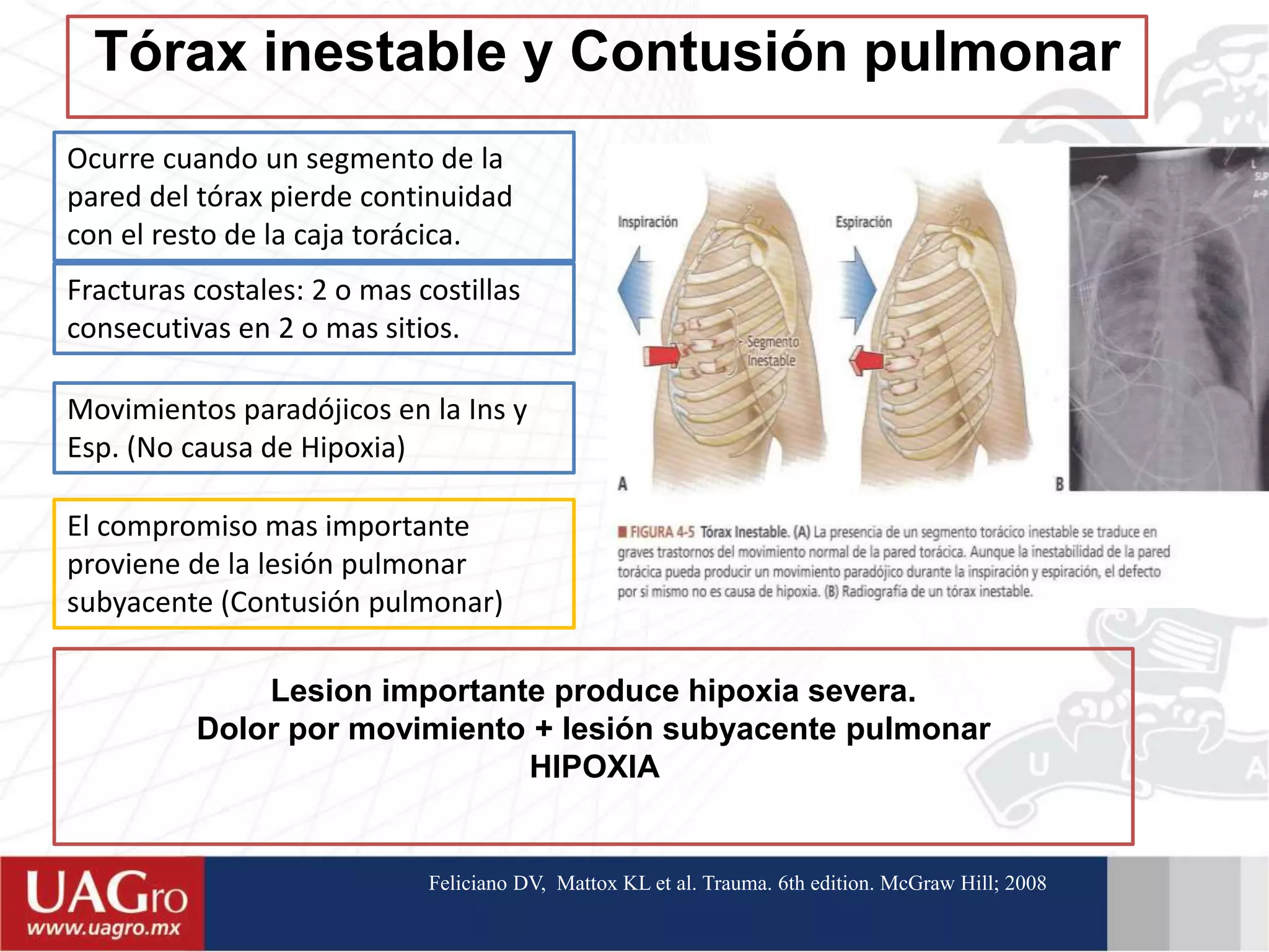 Trauma Torácico | PPTX