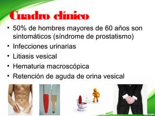 Cuadro clínico
• 50% de hombres mayores de 60 años son
sintomáticos (síndrome de prostatismo)
• Infecciones urinarias
• Litiasis vesical
• Hematuria macroscópica
• Retención de aguda de orina vesical
 