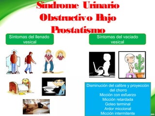 Síndrome Urinario
Obstructivo Bajo
Prostatismo
Síntomas del llenado
vesical
Síntomas del vaciado
vesical
Disminución del calibre y proyección
del chorro
Micción con esfuerzo
Micción retardada
Goteo terminal
Ardor miccional
Micción intermitente
 