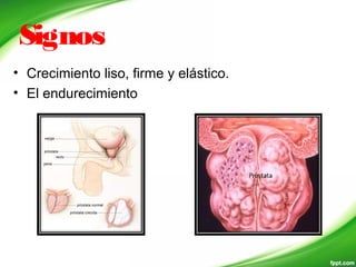Signos
• Crecimiento liso, firme y elástico.
• El endurecimiento
 
