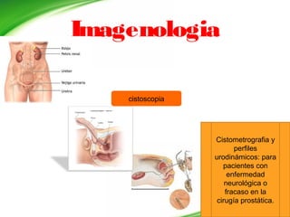 Imagenologia
cistoscopia
Cistometrografia y
perfiles
urodinámicos: para
pacientes con
enfermedad
neurológica o
fracaso en la
cirugía prostática.
 