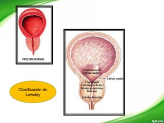 Clasificación de
Lowsley
 