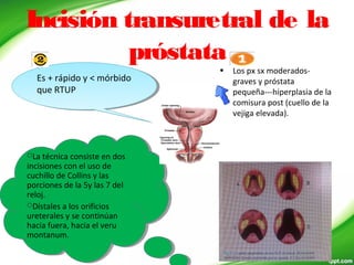 Incisión transuretral de la
próstata
• Los px sx moderados-
graves y próstata
pequeña---hiperplasia de la
comisura post (cuello de la
vejiga elevada).
La técnica consiste en dos
incisiones con el uso de
cuchillo de Collins y las
porciones de la 5y las 7 del
reloj.
Dístales a los orificios
ureterales y se continúan
hacia fuera, hacia el veru
montanum.
La técnica consiste en dos
incisiones con el uso de
cuchillo de Collins y las
porciones de la 5y las 7 del
reloj.
Dístales a los orificios
ureterales y se continúan
hacia fuera, hacia el veru
montanum.
Es + rápido y < mórbido
que RTUP
Es + rápido y < mórbido
que RTUP
 