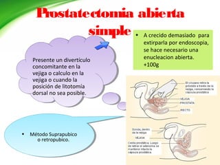 Prostatectomia abierta
simple • A crecido demasiado para
extirparla por endoscopia,
se hace necesario una
enucleacion abierta.
+100g
Presente un divertículo
concomitante en la
vejiga o calculo en la
vejiga o cuando la
posición de litotomía
dorsal no sea posible.
Presente un divertículo
concomitante en la
vejiga o calculo en la
vejiga o cuando la
posición de litotomía
dorsal no sea posible.
• Método Suprapubico
o retropubico.
• Método Suprapubico
o retropubico.
 
