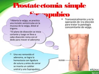 Prostatectomia simple
Suprapubico• Transvesicalmente y es la
operación de 1ra elección
para tratar la patología
concomitante de vejiga.
Abierta la vejiga, se practica
una incisión semicirculas en la
mucosa de la vejiga, distal al
trigono.
El plano de disección se inicia
cortante y luego se lleva a
cabo disección roma con el
dedo para mover el adenoma
Abierta la vejiga, se practica
una incisión semicirculas en la
mucosa de la vejiga, distal al
trigono.
El plano de disección se inicia
cortante y luego se lleva a
cabo disección roma con el
dedo para mover el adenoma
 Una vez removido el
adenoma, se logra la
hemostasia con ligadura
de sutura y antes de cerrar
se inserta un catéter
uretral y uno Suprapubico.
 Una vez removido el
adenoma, se logra la
hemostasia con ligadura
de sutura y antes de cerrar
se inserta un catéter
uretral y uno Suprapubico.
 