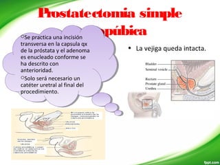 Prostatectomia simple
retropúbica
• La vejiga queda intacta.
Se practica una incisión
transversa en la capsula qx
de la próstata y el adenoma
es enucleado conforme se
ha descrito con
anterioridad.
Solo será necesario un
catéter uretral al final del
procedimiento.
Se practica una incisión
transversa en la capsula qx
de la próstata y el adenoma
es enucleado conforme se
ha descrito con
anterioridad.
Solo será necesario un
catéter uretral al final del
procedimiento.
 
