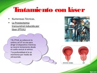 Tratamiento con láser
• Numerosas Técnicas.
• La Prostectomia
transuretral inducida por
láser (PTUIL)
EL PTUIL se coloca en la
uretra y el UT se usa para
dirigir el dispositivo mientras
se recorre lentamente desde
el cuello vesical al vértice.
La profundidad el tx se
monitorea por medio de
ultrasonido.
EL PTUIL se coloca en la
uretra y el UT se usa para
dirigir el dispositivo mientras
se recorre lentamente desde
el cuello vesical al vértice.
La profundidad el tx se
monitorea por medio de
ultrasonido.
 