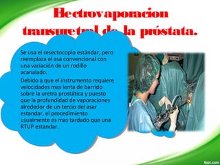 Electrovaporacion
transuretral de la próstata.
Se usa el resectocopio estándar, pero
reemplaza el asa convencional con
una variación de un rodillo
acanalado.
Debido a que el instrumento requiere
velocidades mas lenta de barrido
sobre la uretra prostática y puesto
que la profundidad de vaporaciones
alrededor de un tercio del asar
estandar, el procedimiento
usualmente es mas tardado que una
RTUP estandar.
Se usa el resectocopio estándar, pero
reemplaza el asa convencional con
una variación de un rodillo
acanalado.
Debido a que el instrumento requiere
velocidades mas lenta de barrido
sobre la uretra prostática y puesto
que la profundidad de vaporaciones
alrededor de un tercio del asar
estandar, el procedimiento
usualmente es mas tardado que una
RTUP estandar.
 