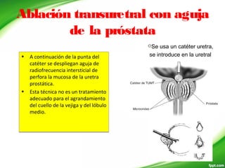 Ablación transuretral con aguja
de la próstata
• A continuación de la punta del
catéter se despliegan aguja de
radiofrecuencia intersticial de
perfora la mucosa de la uretra
prostática.
• Esta técnica no es un tratamiento
adecuado para el agrandamiento
del cuello de la vejiga y del lóbulo
medio.
• A continuación de la punta del
catéter se despliegan aguja de
radiofrecuencia intersticial de
perfora la mucosa de la uretra
prostática.
• Esta técnica no es un tratamiento
adecuado para el agrandamiento
del cuello de la vejiga y del lóbulo
medio.
Se usa un catéter uretra,
se introduce en la uretral
 