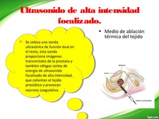 Ultrasonido de alta intensidad
focalizado.
• Medio de ablación
térmica del tejido
 Se coloca una sonda
ultrasónica de función dual en
el recto, esta sonda
proporciona imágenes
transrectales de la prostata y
también ráfagas cortas de
energía de ultrasonido
focalizado de alta intensidad,
que calientan el tejido
prostático y provocan
necrosis coagulativa.
 Se coloca una sonda
ultrasónica de función dual en
el recto, esta sonda
proporciona imágenes
transrectales de la prostata y
también ráfagas cortas de
energía de ultrasonido
focalizado de alta intensidad,
que calientan el tejido
prostático y provocan
necrosis coagulativa.
 