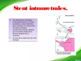 Stent intrauretrales.
• Son dispositivos colocados
endoscopicamente en la fosa
prostática y están diseñados
para mantener sin obstrucción
la uretra prostática.
Usualmente quedan cubierto
por el urotelio alcabo de 4-
6meses despues de su
insercion.
• Se usan para esperanzas de vida
limitada
• Son dispositivos colocados
endoscopicamente en la fosa
prostática y están diseñados
para mantener sin obstrucción
la uretra prostática.
Usualmente quedan cubierto
por el urotelio alcabo de 4-
6meses despues de su
insercion.
• Se usan para esperanzas de vida
limitada
 