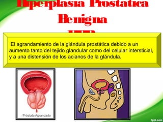 Hiperplasia Prostática
Benigna
HPBEl agrandamiento de la glándula prostática debido a un
aumento tanto del tejido glandular como del celular intersticial,
y a una distensión de los acianos de la glándula.
 