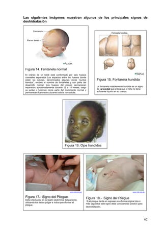 Las siguientes imágenes muestran algunos de los principales signos de
deshidratación




 Figura 14. Fontanela normal
 El cráneo de un bebé está conformado por seis huesos
 craneales separados Los espacios entre los huesos donde
 están las suturas, denominados algunas veces “puntos                     Figura 15. Fontanela hundida
 blandos”, reciben el nombre de fontanelas y son parte del
 desarrollo normal. Los huesos del cráneo permanecen
 separados aproximadamente durante 12 a 18 meses, luego                   La fontanela notablemente hundida es un signo
 se juntan o fusionan como parte del crecimiento normal y                 de gravedad que indica que el niño no tiene
                                                                          suficiente líquido en su cuerpo.
 permanecen fusionados durante toda la vida adulta.




                                        Figura 16. Ojos hundidos




                                             www.rcip.org.es                                                  www.rcip.org.es


 Figura 17.- Signo del Pliegue                                 Figura 18.- Signo del Pliegue
 Debe efectuarse en la región abdominal del paciente,
                                                               Si el pliegue tarda en regresar a su forma original dos o
 utilizando los dedos pulgar e índice para formar el
                                                               más segundos este signo debe considerarse positivo para
 pliegue.
                                                               deshidratación.




                                                                                                                            62
 