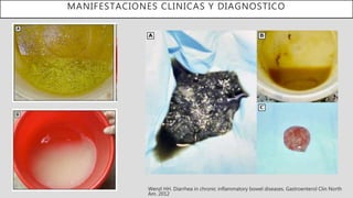 MANIFESTACIONES CLINICAS Y DIAGNOSTICO
Wenzl HH. Diarrhea in chronic inflammatory bowel diseases. Gastroenterol Clin North
Am. 2012
 