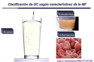 Clasificación de DC según características de la MF Acuosa Esteatorrea Inflamatoria Laine L. Gastroenterol 2004;127:287-293 