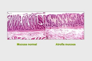 Mucosa normal Atrofia mucosa 