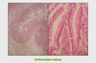 Enfermedad celíaca 