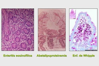 Enteritis eosinofílica Abetalipoproteinemia Enf. de Whipple 