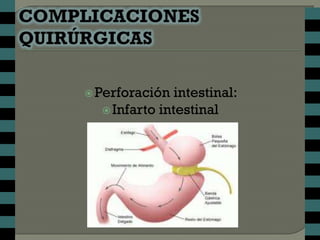  Perforación  intestinal:
   Infarto intestinal
 