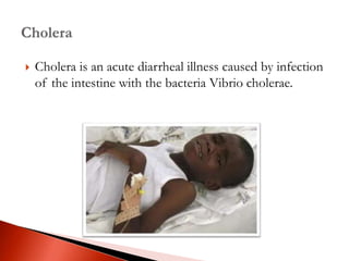  Cholera is an acute diarrheal illness caused by infection
of the intestine with the bacteria Vibrio cholerae.
 