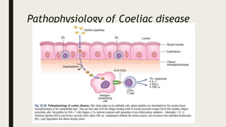 Pathophysiology of Coeliac disease
 