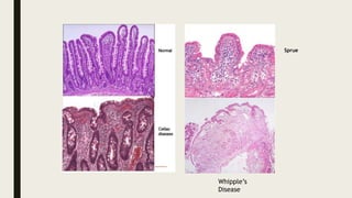 Sprue
Whipple’s
Disease
 