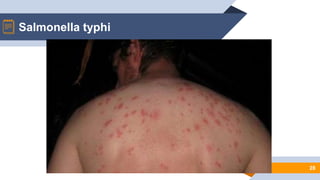 28
Salmonella typhi
 