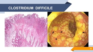 33
CLOSTRIDIUM DIFFICILE
 