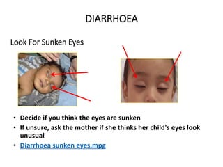 Look For Sunken Eyes
• Decide if you think the eyes are sunken
• If unsure, ask the mother if she thinks her child's eyes look
unusual
• Diarrhoea sunken eyes.mpg
DIARRHOEA
DIARRHOEA
 